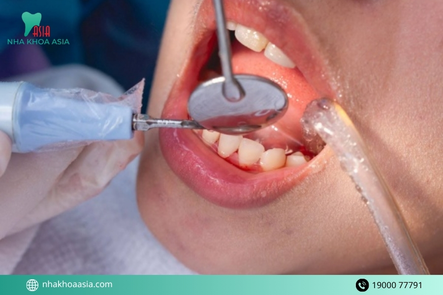 Lấy cao răng bị ê buốt có bình thường không?