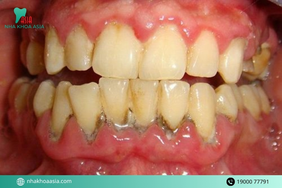 10 lý do lấy cao răng bị ê buốt thường gặp bạn nên biết