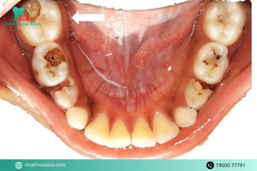 10 lý do lấy cao răng bị ê buốt thường gặp bạn nên biết
