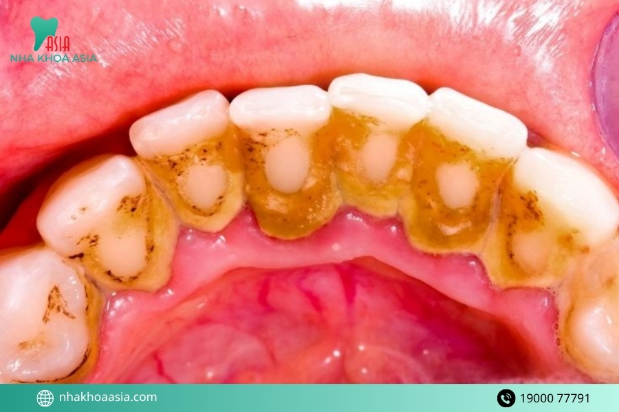 Cách cải thiện lấy cao răng bị ê buốt chuẩn nha khoa