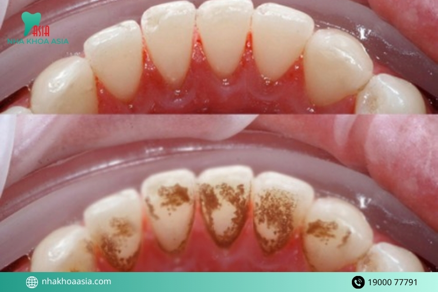 Dấu hiệu lấy cao răng bị ê buốt cần đến nha khoa kiểm tra