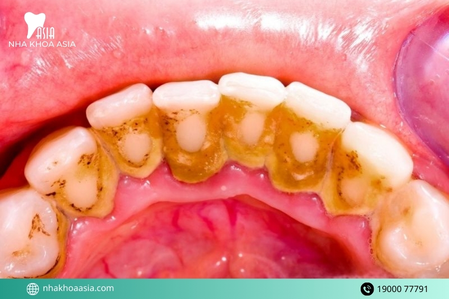 Lấy cao răng nhiều lần có hại không?