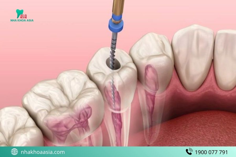 Lấy tủy răng có đau không?