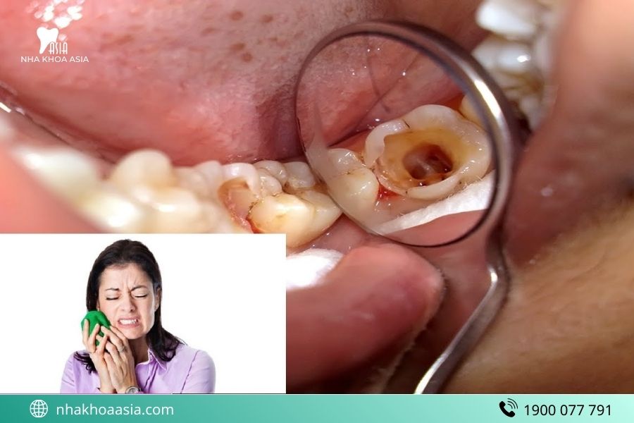 Lấy tủy răng lần 2 có đau không