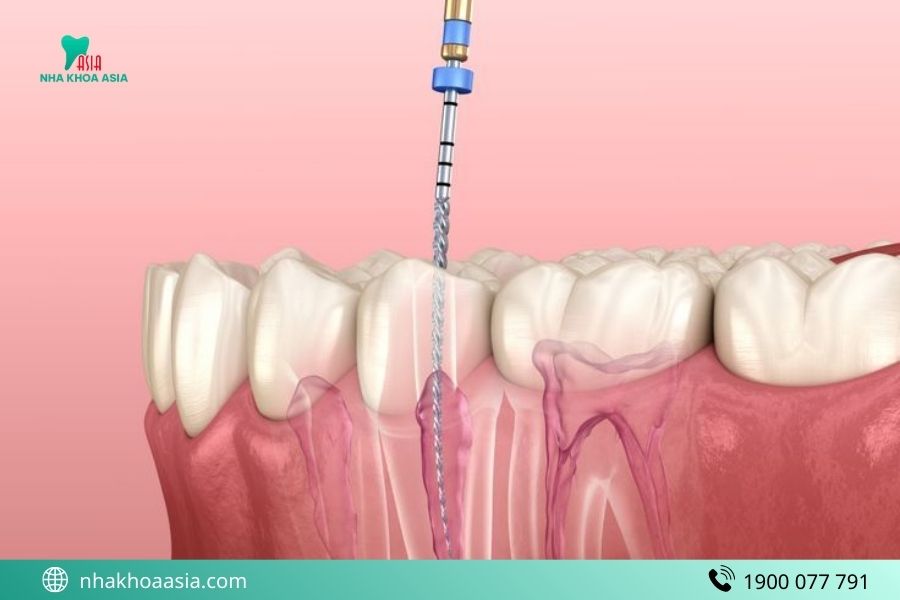 Lấy tủy răng ở đâu uy tín TP.HCM