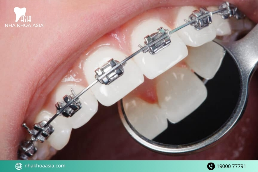 Lợi ích và tác hại của niềng răng 12 sự thật cần biết