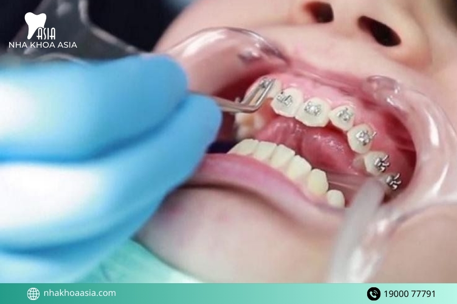 Lợi ích và tác hại của niềng răng 12 sự thật cần biết