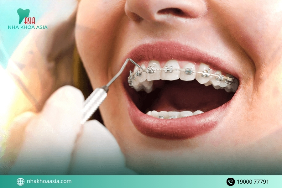 Những trường hợp cần cân nhắc trước khi niềng răng