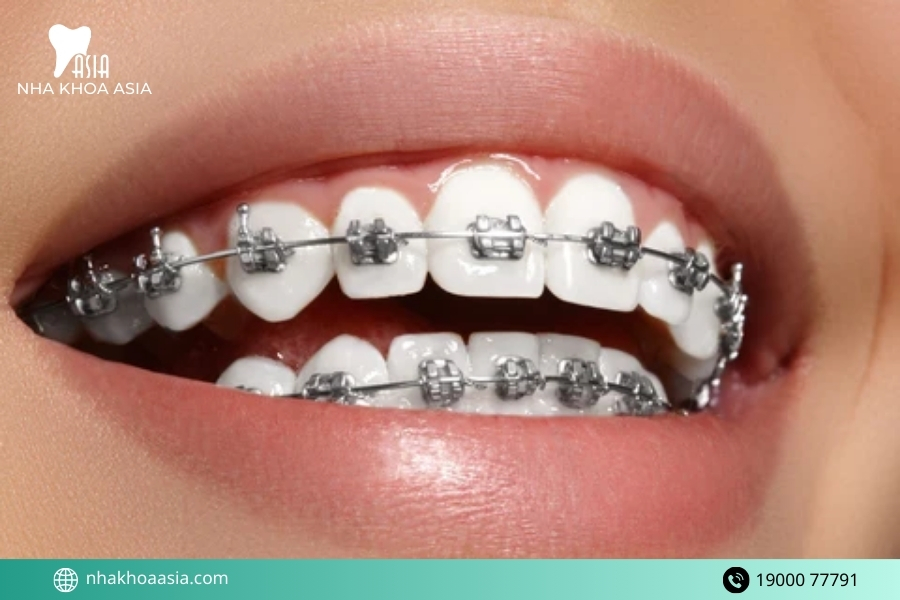 Một số trường hợp nên niềng răng càng sớm càng tốt