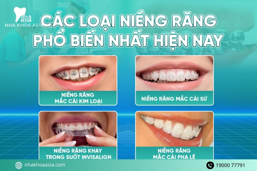 Các phương pháp niềng răng phổ biến hiện nay
