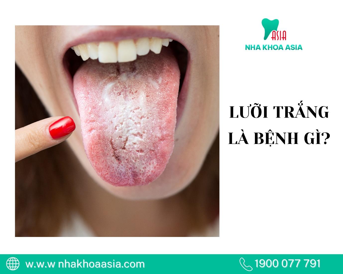 Bệnh lưỡi trắng là gì, nguyên nhân do đâu?