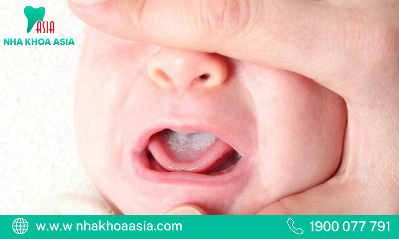 Cách cải thiện tình trạng lưỡi trắng