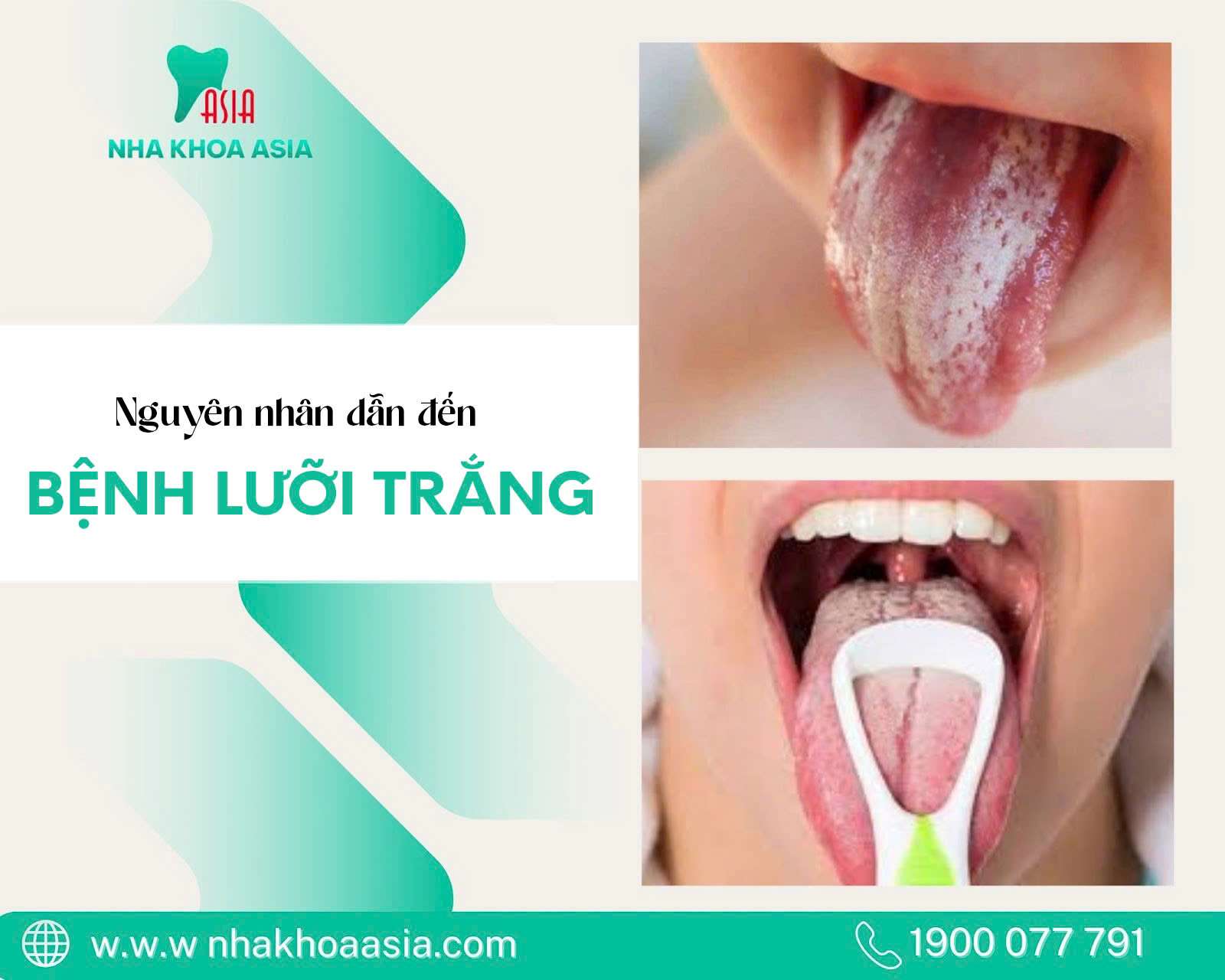 Các nguyên nhân phổ biến gây nên lưỡi trắng