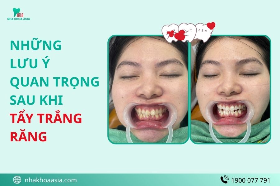 Những lưu ý quan trọng sau khi tẩy trắng răng