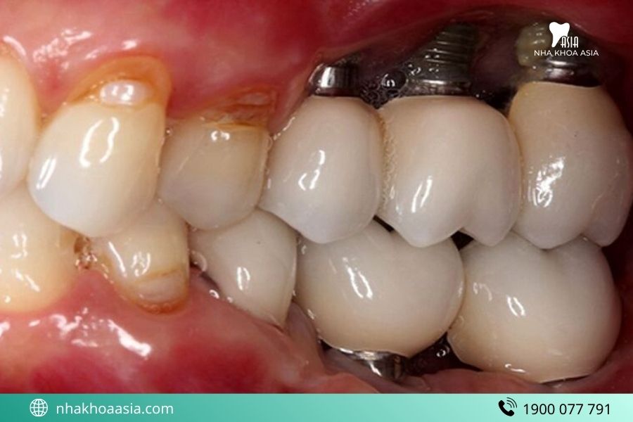 Lý do hối hận sau khi trồng Implant