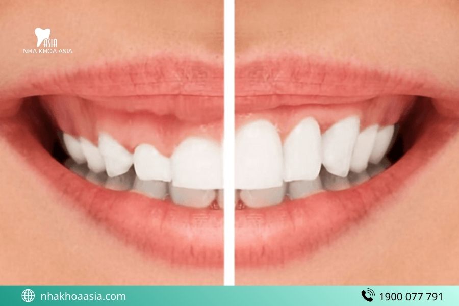 Mài xương ổ răng có giảm hô không