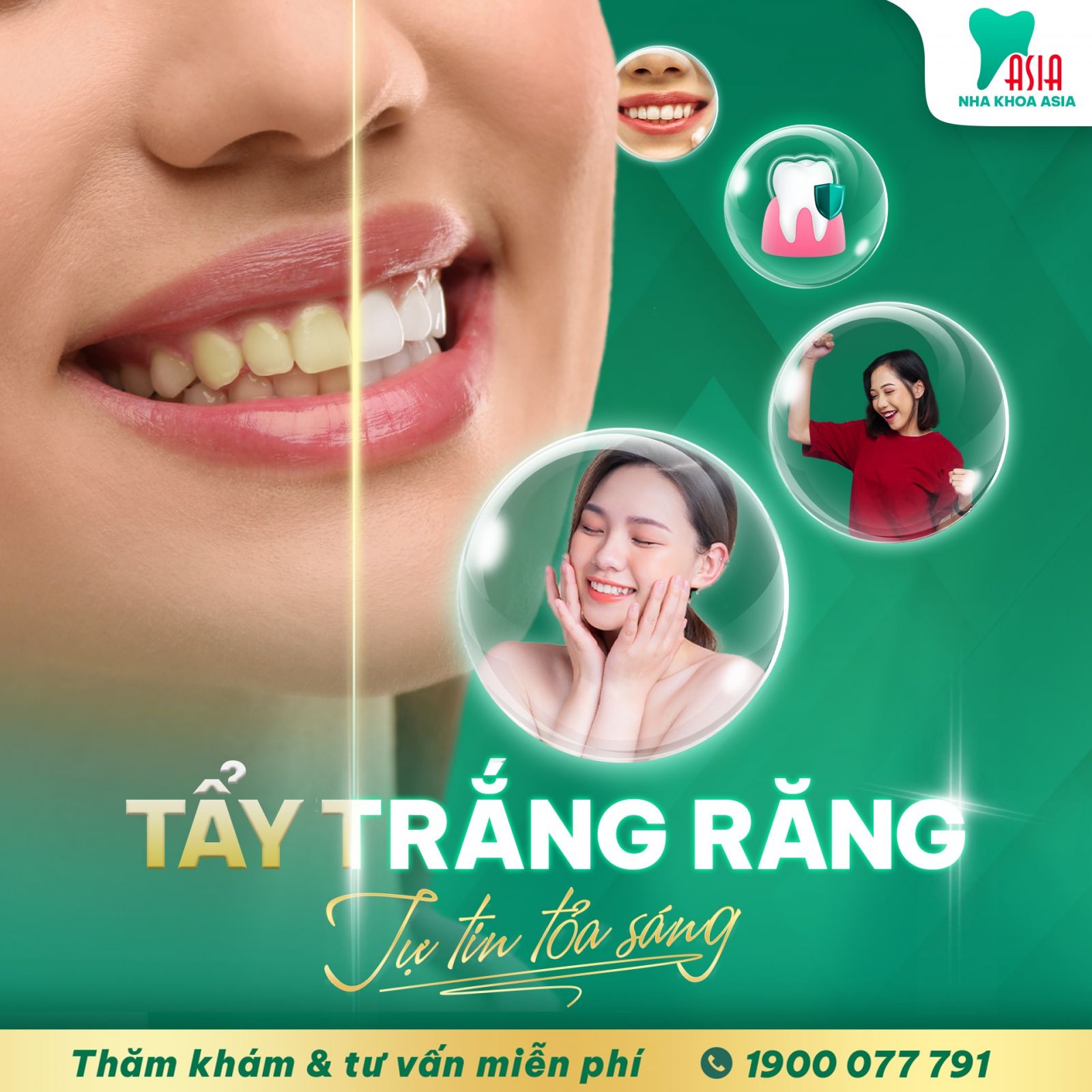  Răng bị sỉn màu bị vàng và răng sau khi mang tẩy trắng răng
