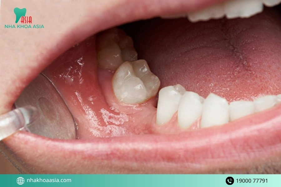 Cách phục hồi hiệu quả khi mất răng hàm được chuyên gia khuyến nghị