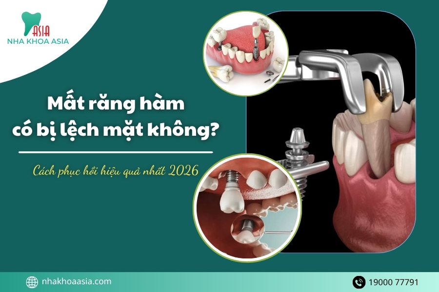 Mất răng hàm có bị lệch mặt không? Cách phục hồi hiệu quả nhất 2026
