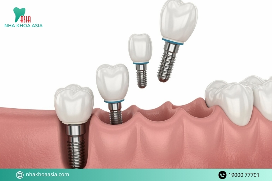 Những dấu hiệu cho thấy mất răng đang ảnh hưởng khuôn mặt