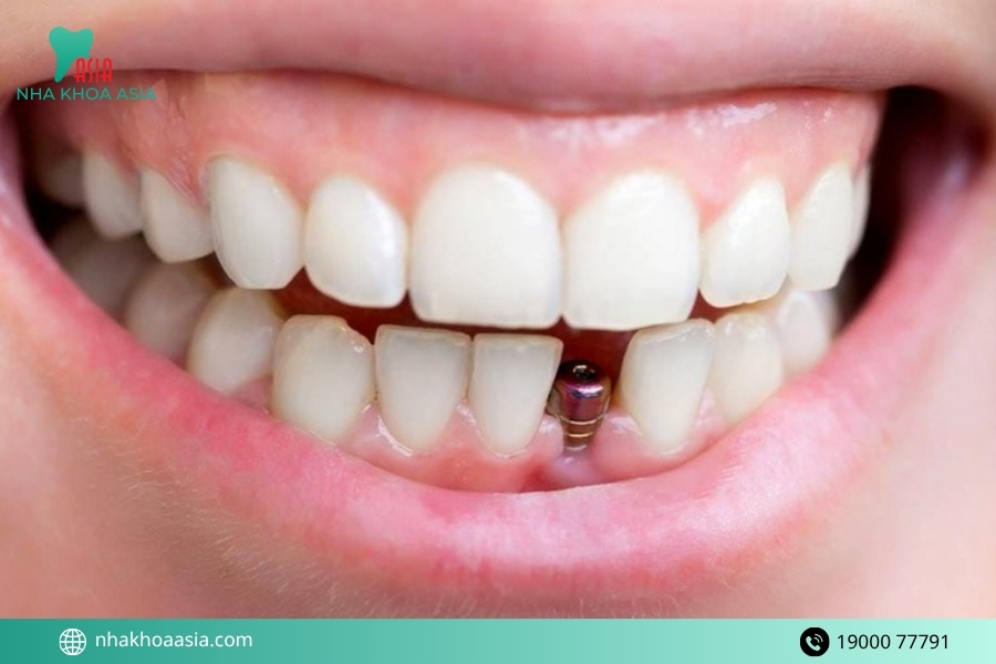 Mất răng hàm có tự hồi phục lại khuôn mặt được không?