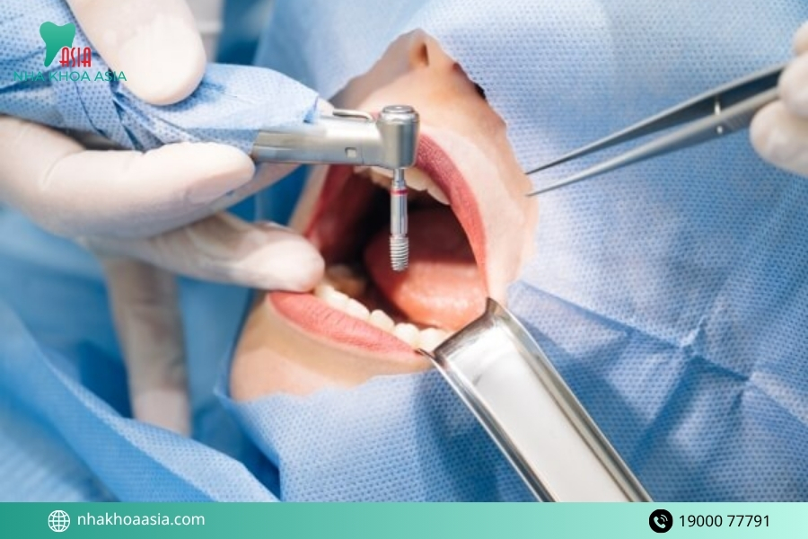 Cách phục hồi hiệu quả khi mất răng hàm được chuyên gia khuyến nghị