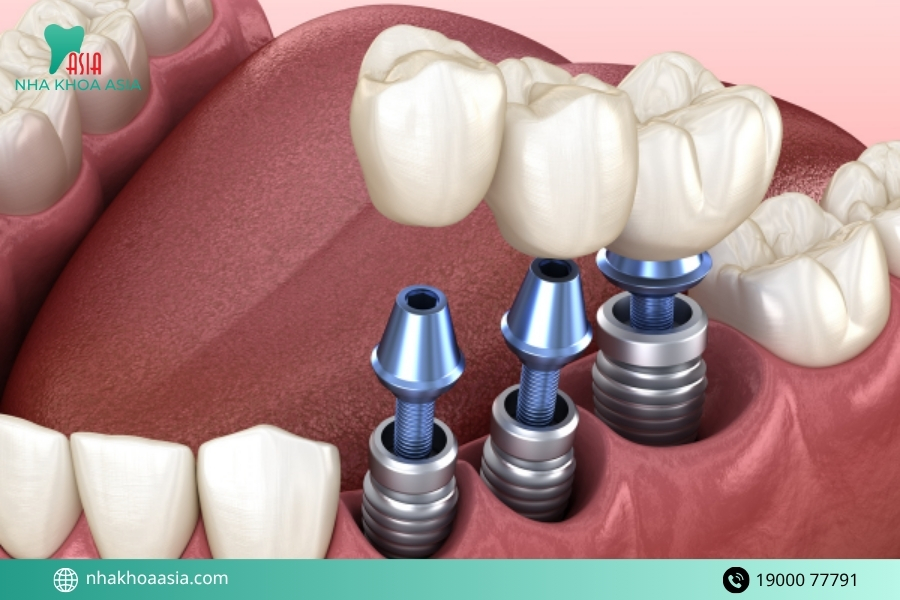 Trồng Implant có giúp mặt cân đối hơn không?