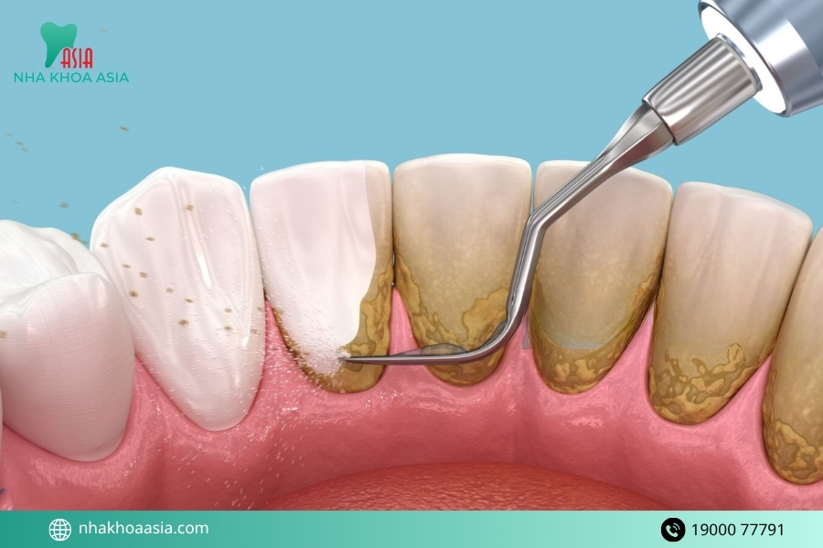 Các phương pháp phục hồi men răng tại nha khoa