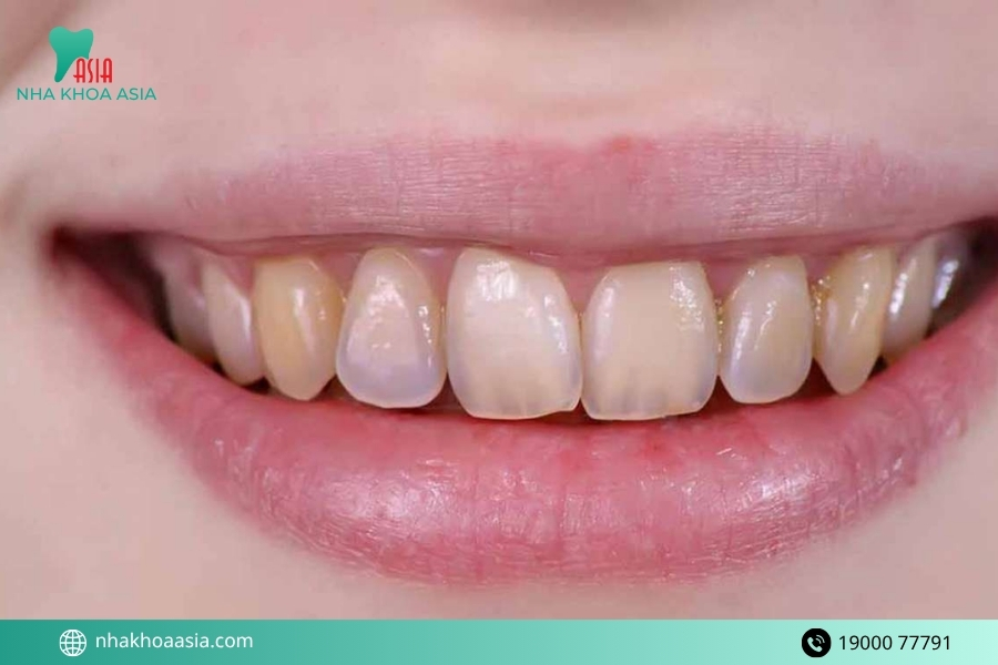 Dấu hiệu cho thấy men răng đang bị tổn thương