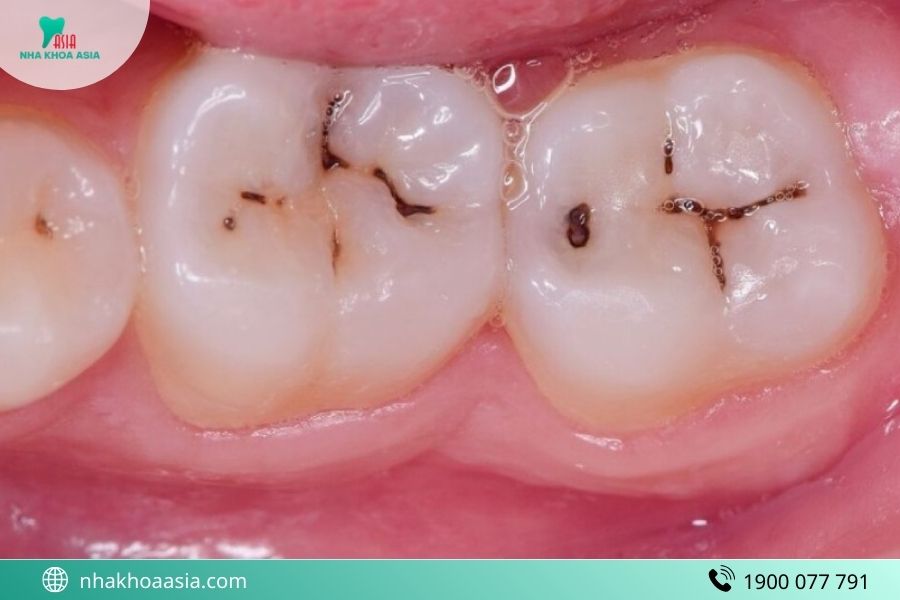 Mẹo trị sâu răng đau nhức cho trẻ ngay tại nhà