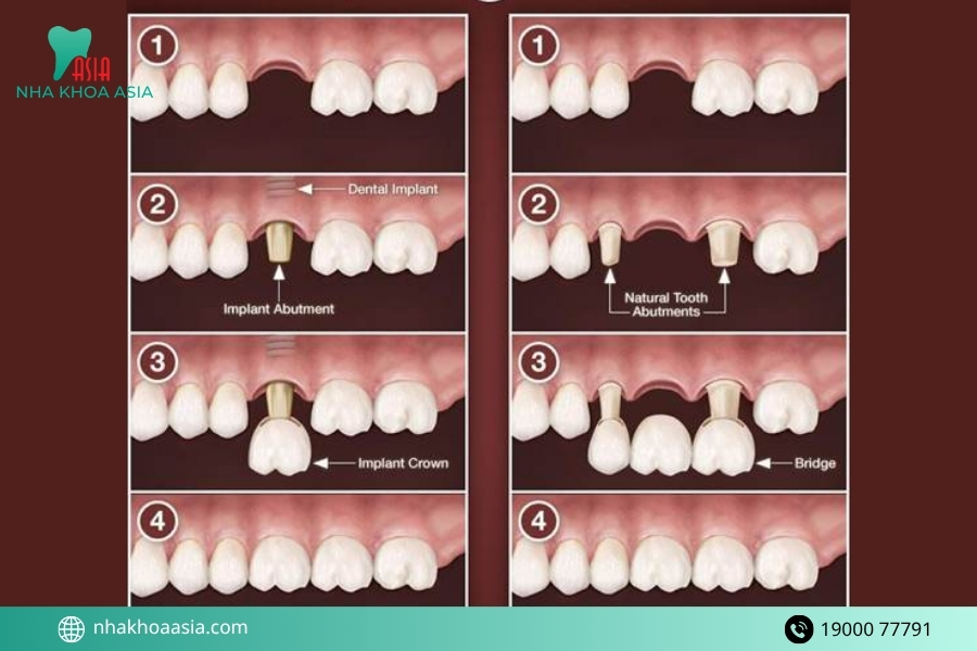 Vì sao trồng răng implant đang là xu hướng hiện nay?