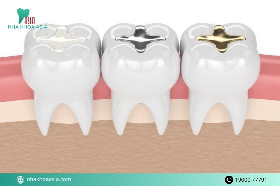  Nguyên nhân khiến bệnh nhân bị ê răng sau khi trám