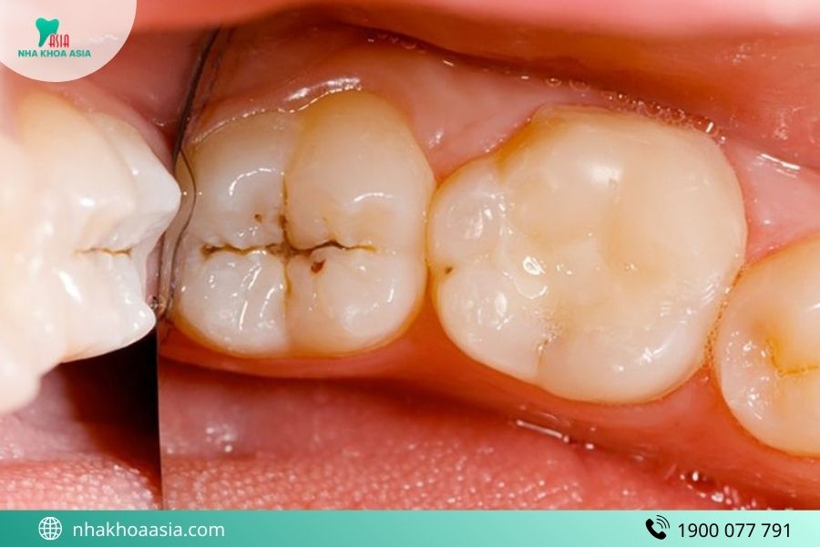 Nguyên nhân trẻ bị sâu răng đau nhức