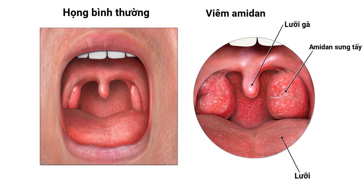 Viêm amidan, viêm họng, viêm xoang có thế gây ra máu trong nước bọt