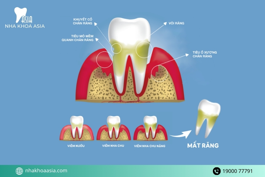 Những hệ luỵ nếu không chưa trị viêm nướu răng kịp thời