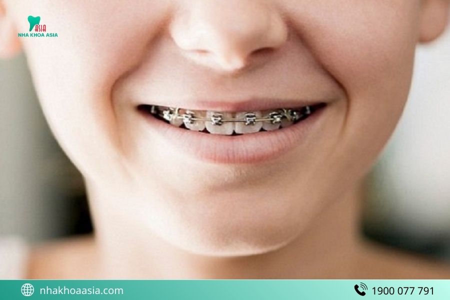 Những lưu ý khi niềng răng trẻ em