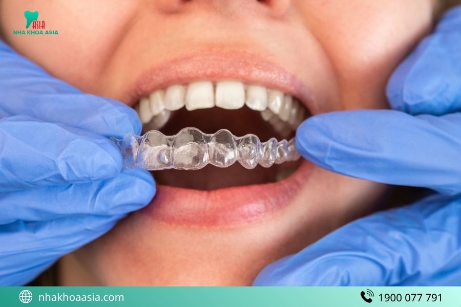Niềng Invisalign có đau không