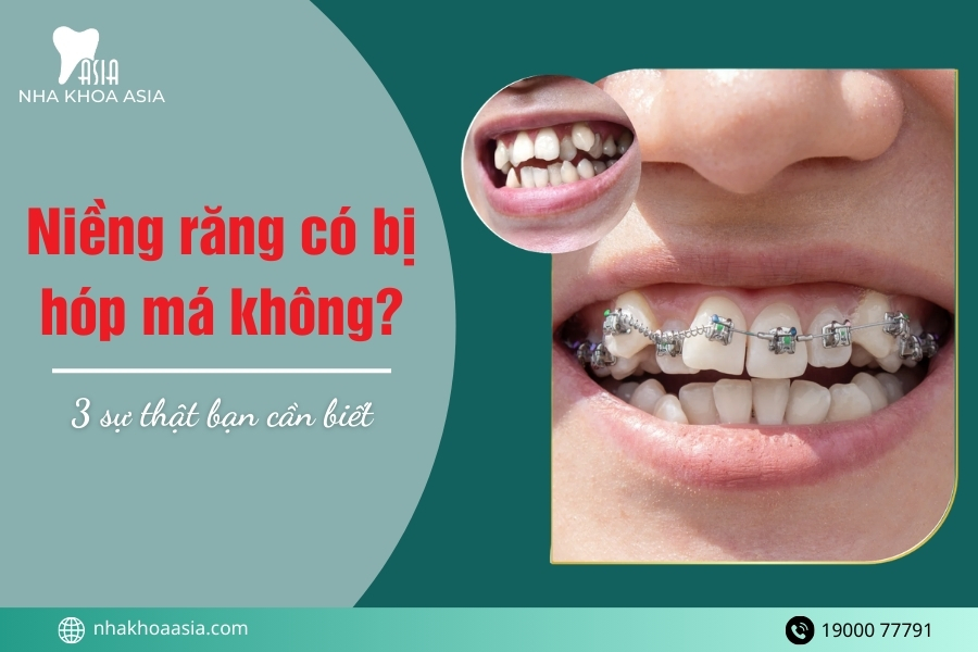 Niềng răng có bị hóp má không? 3 sự thật bạn cần biết