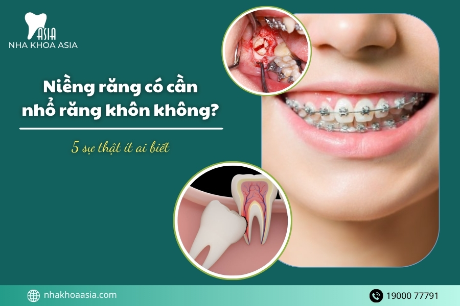 Niềng răng có cần nhổ răng khôn không? 5 sự thật ít ai biết