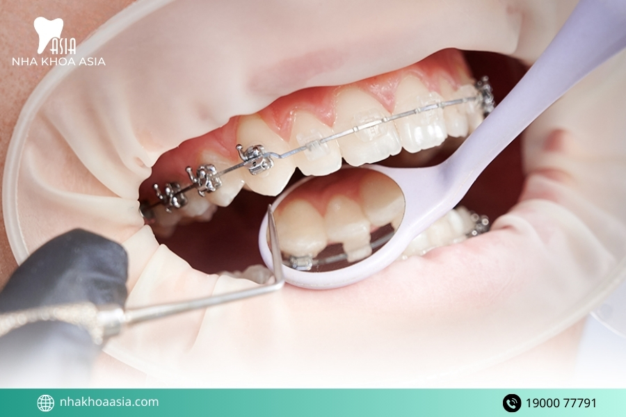 Những yếu tố quyết định có nhổ răng khôn hay không
