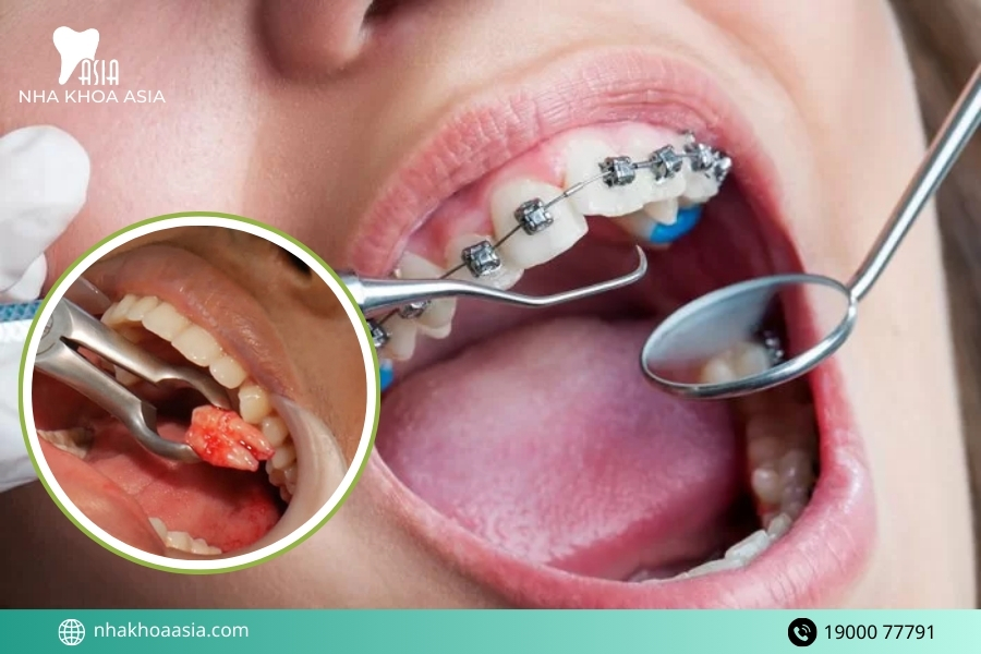 Vì sao răng khôn có thể ảnh hưởng đến quá trình niềng răng?