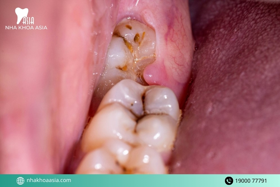 Răng khôn có thể làm xô lệch răng sau niềng không?