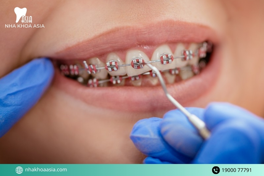 4 Trường hợp niềng răng không cần nhổ răng khôn