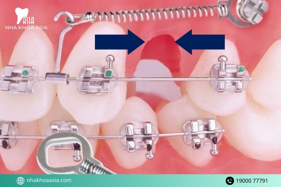 Nhổ răng khôn xong bao lâu thì niềng răng được?