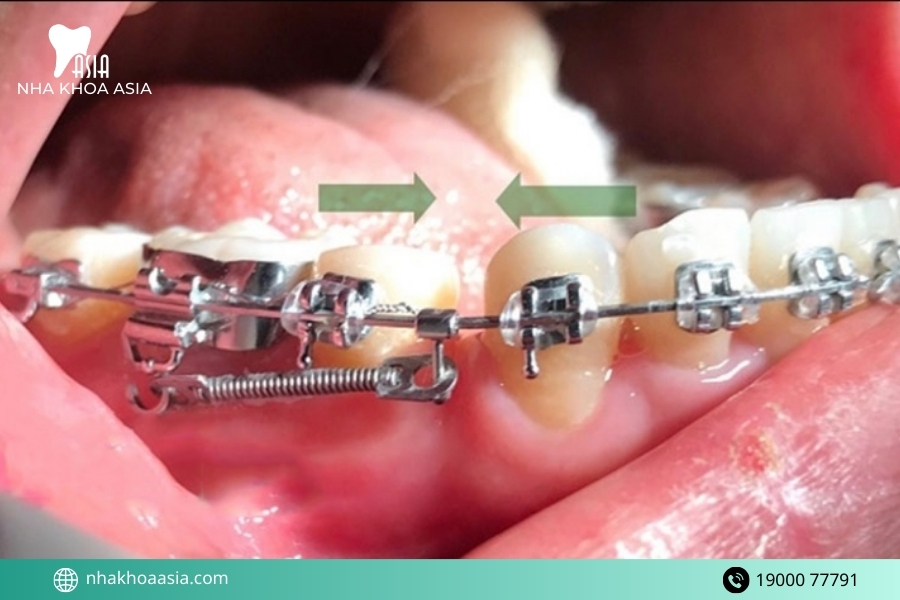 Những lưu ý quan trọng nếu bạn chuẩn bị niềng răng
