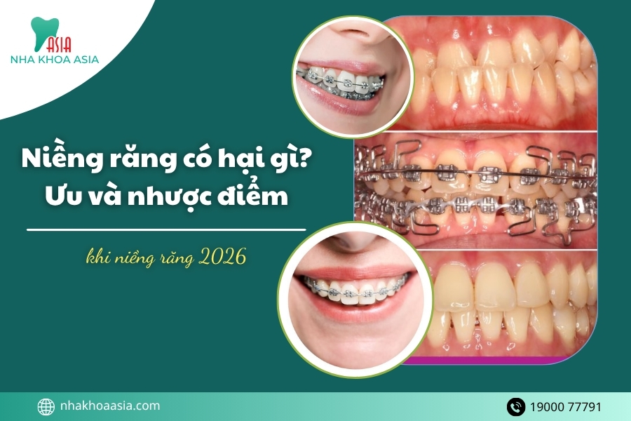 Niềng răng có hại gì không? Ưu và nhược điểm khi niềng răng 2026