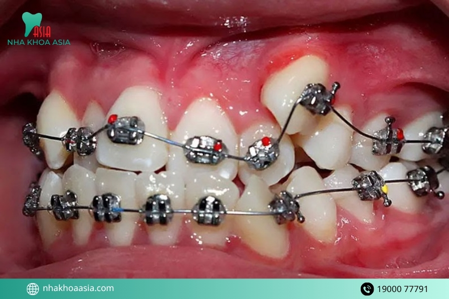 Niềng răng có hại gì không? Nhược điểm khi niềng răng cần cân nhắc