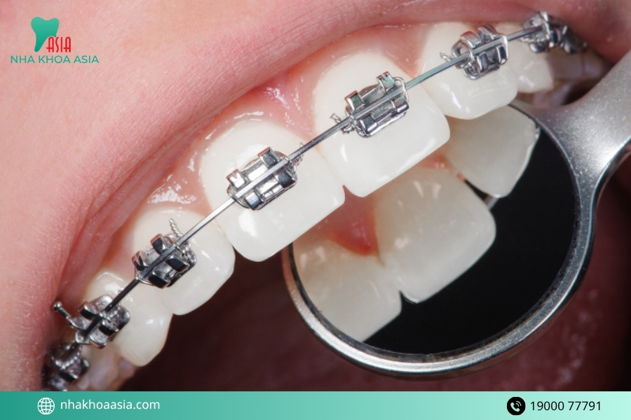 Trường hợp nên niềng răng càng sớm càng tốt