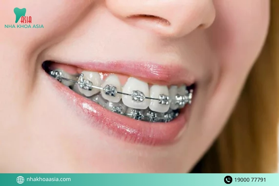 Làm sao để niềng răng an toàn và hạn chế rủi ro?