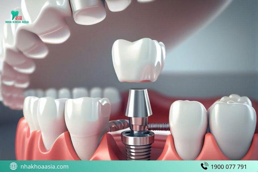 Trồng răng Implant có đau không